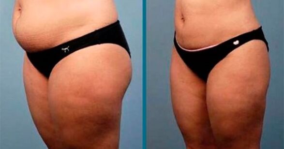 Methode fir Gewiicht ze verléieren ëm 10 Kilogramm an engem Mount